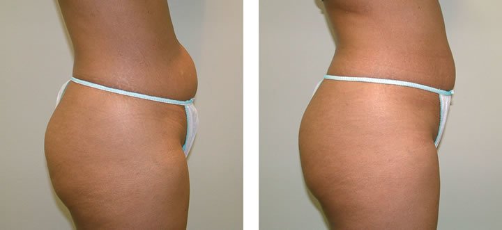 VelaShape2-before-after